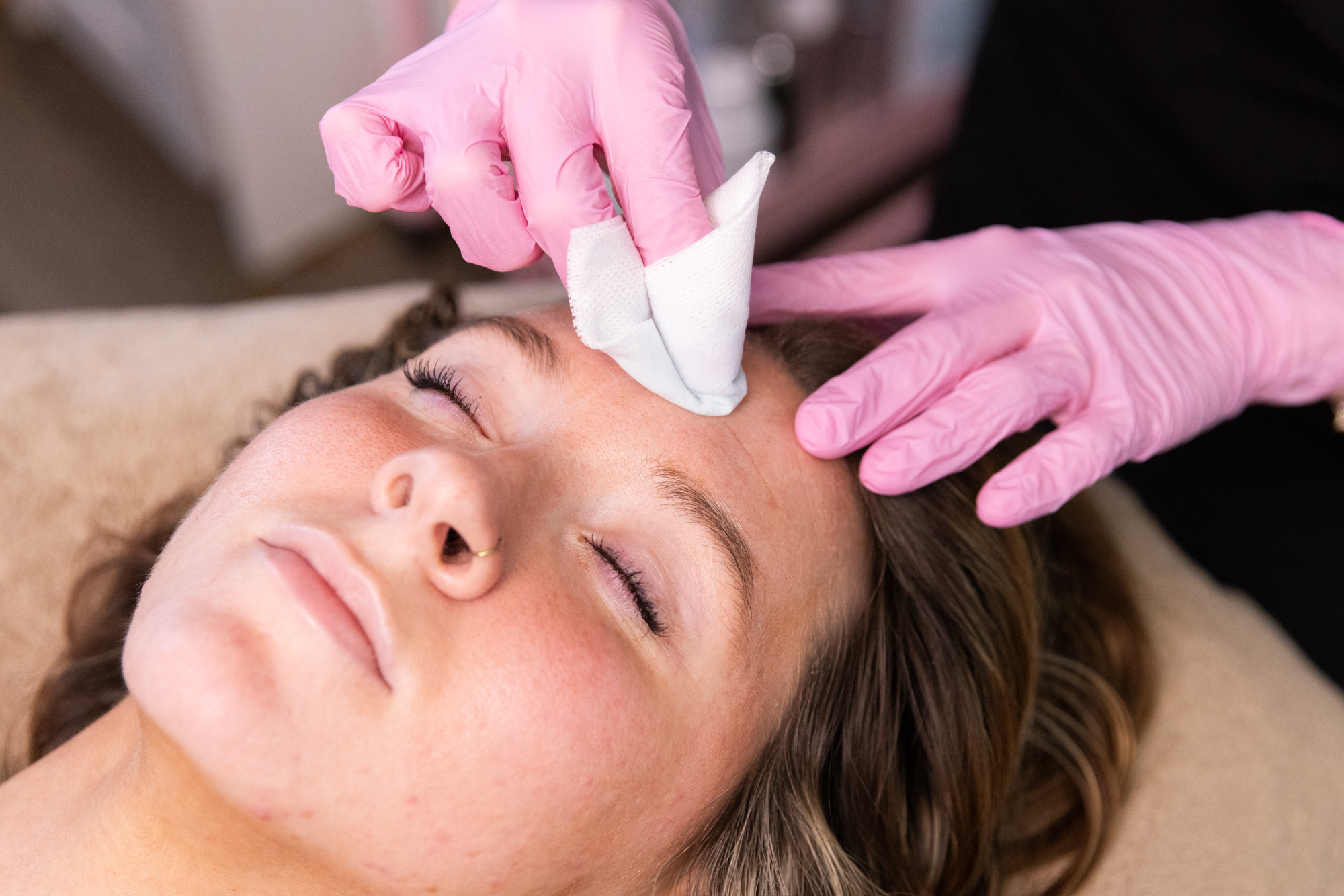 A Medical Spa NP practitioner cleans a patient's skin prior to administering microneedling with PRP in Lancaster.