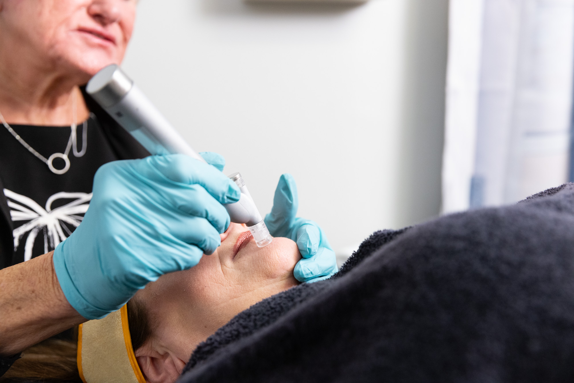 A patient undergoes microneedling, one of our popular treatments for facial volume loss in Lancaster.