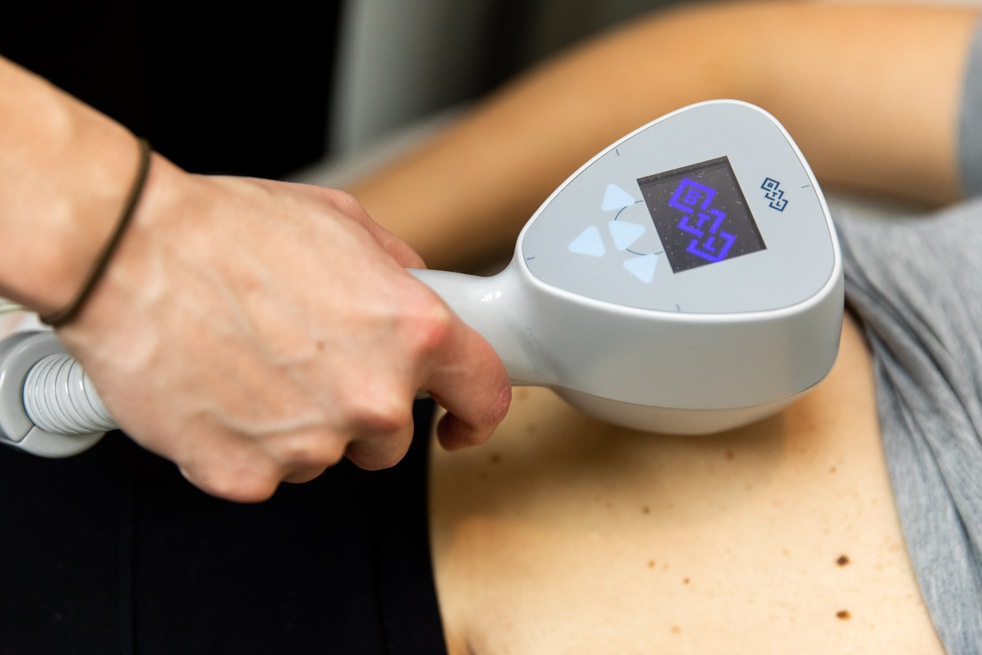  A provider uses the Exilis Ultra 360 device to treat a patient's abdominal skin and fat, a procedure commonly used as part of cellulite treatment in Lancaster.