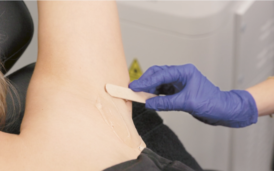 A provider prepares a patient's underarm for laser hair reduction in Lancaster.